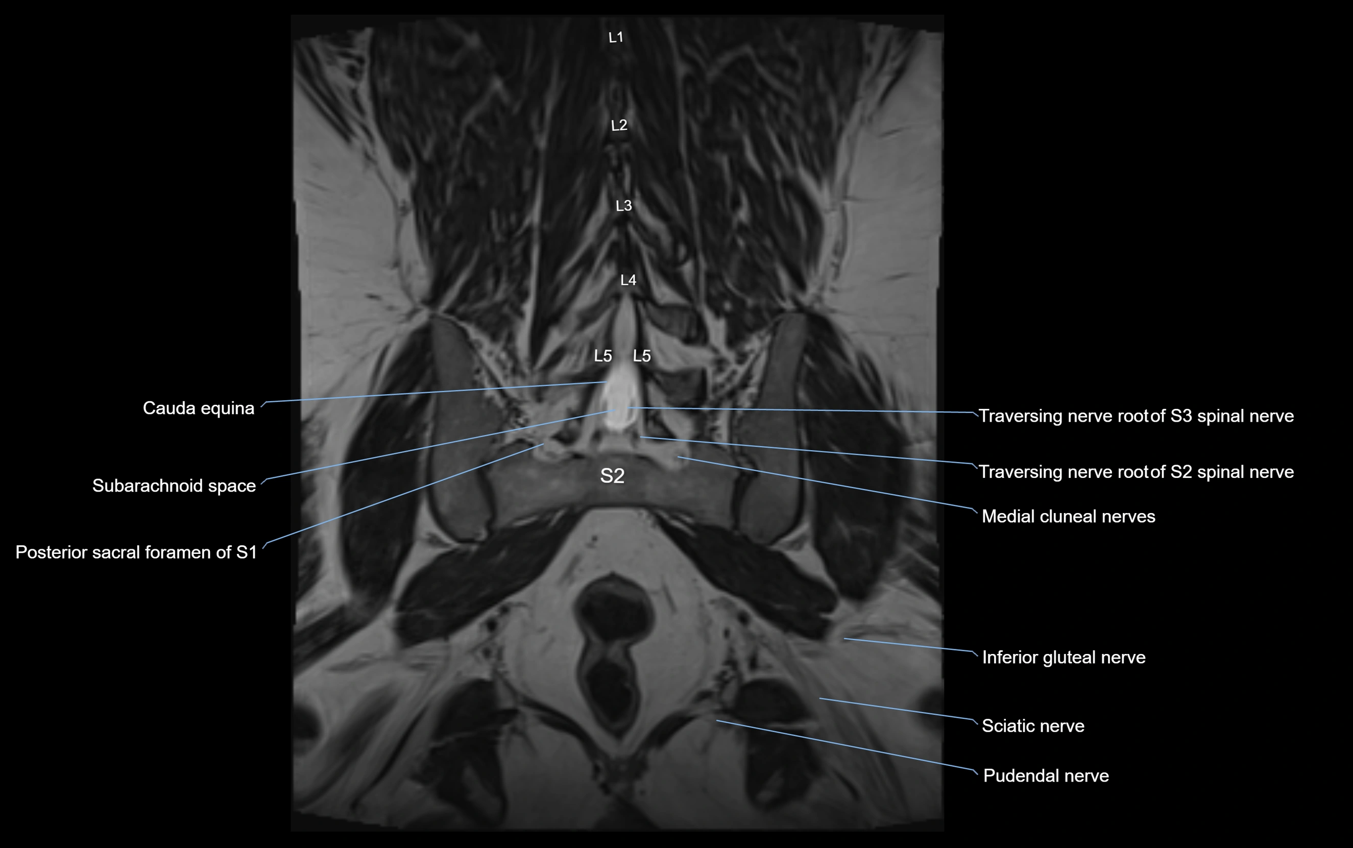 MR lumbosacral plexus cross sectional anatomy 3T  radiology  image-img-09001-00055.webp